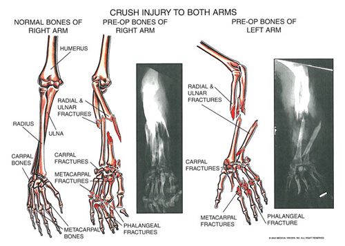 arms_1 - Owens & Mulherin