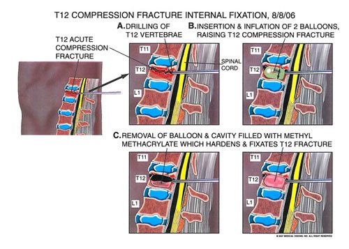 compression_fracture_spine - Owens & Mulherin