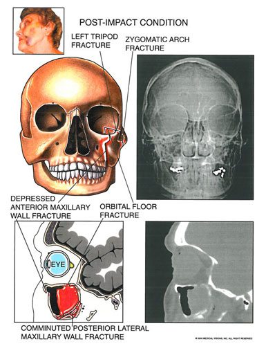 facial_fractures - Owens & Mulherin