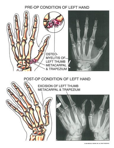 osteomyelitis - Owens & Mulherin