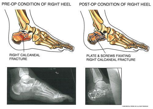 shattered_calcaneal_1 - Owens & Mulherin