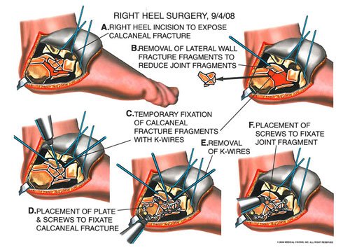 shattered_calcaneal_2 - Owens & Mulherin