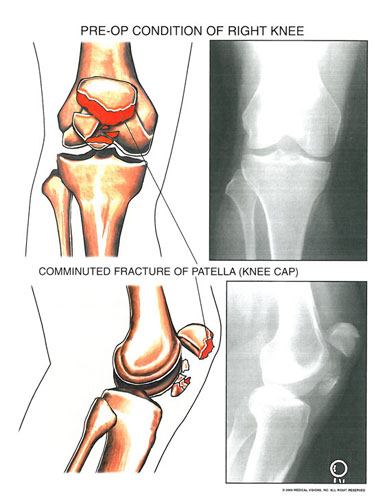 shattered_patella_1 - Owens & Mulherin