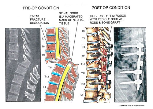 spinal_chord_severance_2 - Owens & Mulherin