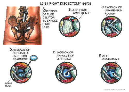 three_level_disrectomy_1 - Owens & Mulherin