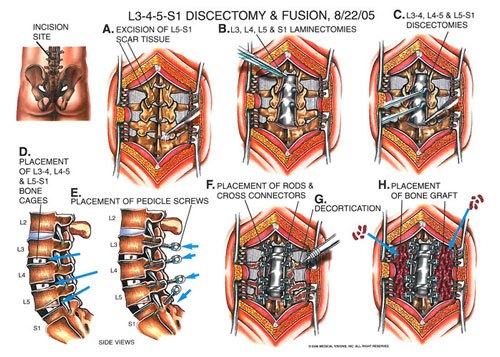 three_level_disrectomy_2 - Owens & Mulherin