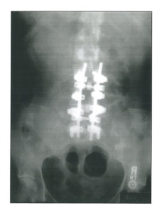 three_level_disrectomy_3 - Owens & Mulherin